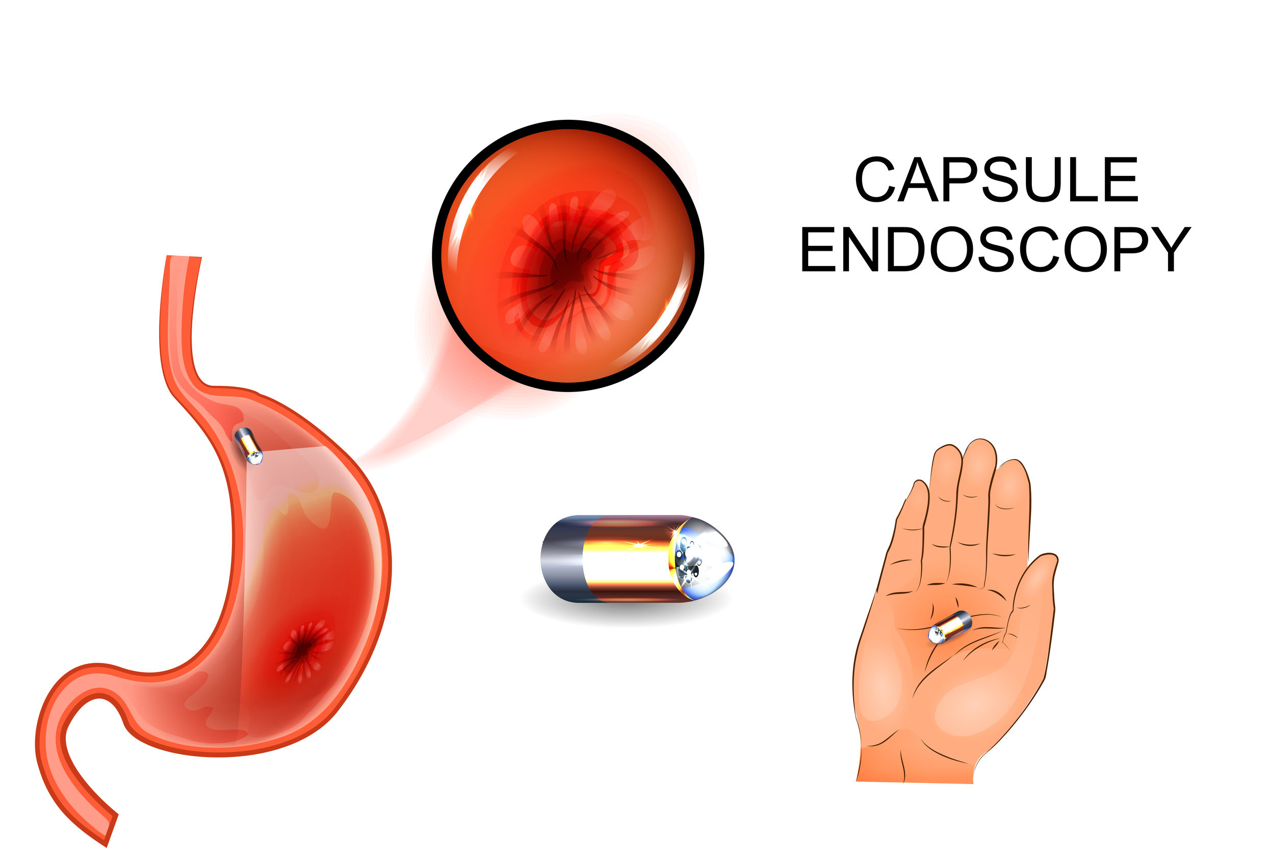 How Do You Prepare for an Endoscopy?