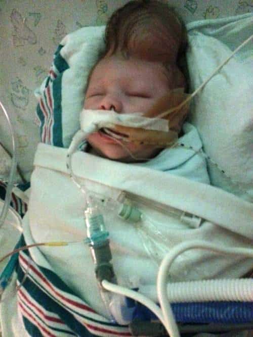 Baby Boy Born With His Brain Outside His Skull Stuns Doctors By ...