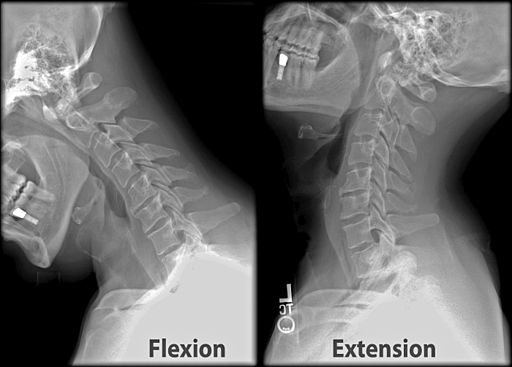 Oblique Cervical Spine Xray