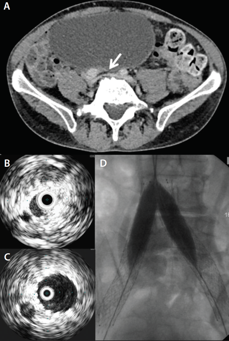 CT Scanogram For Limb Length Discrepancy In Comminuted, 48% OFF