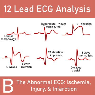 Killer ECG Patterns: Part • LITFL • ECG Library, 60% OFF