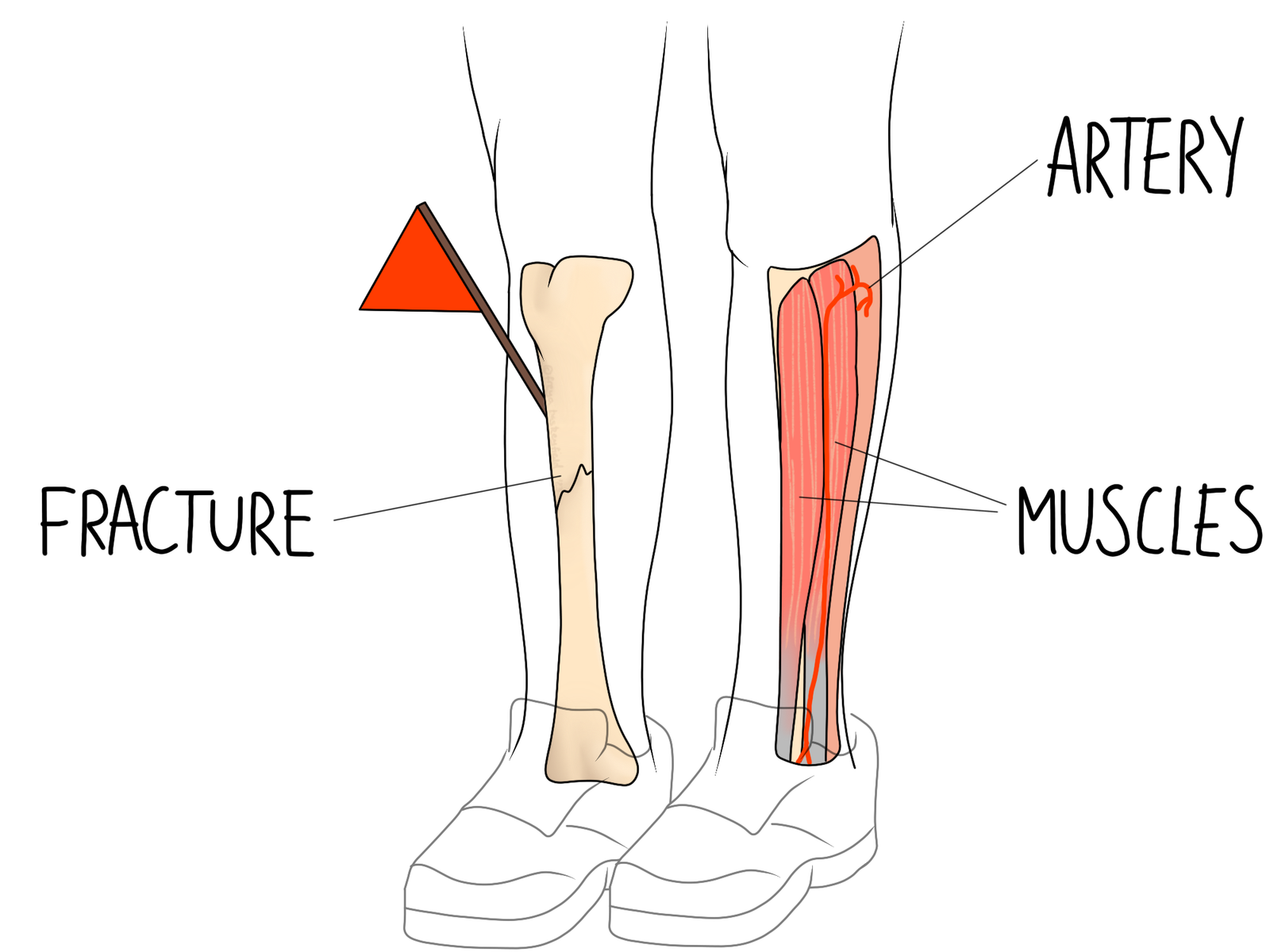 Compartment Syndrome