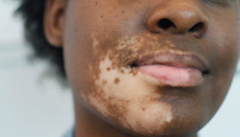 Vitiligo