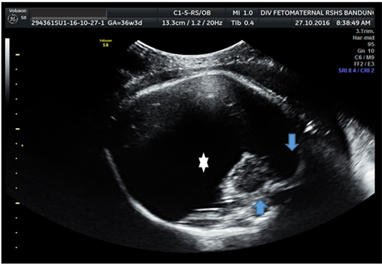 Alobar Holoprosencephaly with Duodenal Atresia: A Case Report