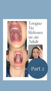 Margaret Barry• FNTP, CPT, PCES on Instagram: "Part 2 of this series, talking about my experience with a tongue release as an adult!❓❓Question: would you have a knee replacement, and skip the rehabilitative therapy before and after the surgery? I hope not!! Likewise, it is important to undergo preparatory measures ahead of and after a tongue tie release. I believe the preparation I did with the rest of my body and tissues (myofunctional therapy, myofascial release, and cranial work) allowed me t