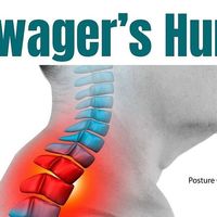 Backpain | Sciatica | Mobility on Instagram: "🚨SAY GOODBYE TO DOWAGER’S HUMP!

Are you struggling with a hump where your neck meets your upper back?

This common issue, known as Dowager’s Hump, occurs when your spine loses its healthy curve and rounds into a C-shape, putting pressure on the neck and moving the head forward. Often resulting from poor posture and aging, it can limit neck mobility and impact your appearance, even if it doesn’t always cause discomfort.

🚨 Don’t let Dowager’s Hump impact your posture and comfort! It’s more than just a cosmetic concern—it can lead to neck pain and misalignment.

Take action today! Just a few minutes of daily exercises can make a world of difference.

Try these targeted exercises to strengthen and align the muscles, helping to reduce that hump 