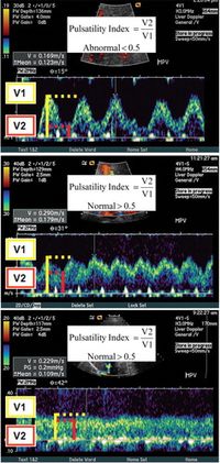 Doppler US of the Liver Made Simple | RadioGraphics