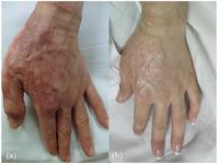 Hand burn posted to website Journals Sage Pub by user Joy Tag on February 23rd 2018. Photo from: https://journals.sagepub.com/doi/10.1177/2059513118758510