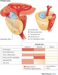 WK 6 PROSTATE Inflammation in prostate carcinogenesis