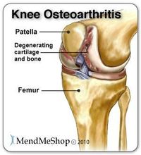 It is not the bones inside the knee that provide stability. It is the soft tissue (tendons, ligaments, muscles, menisci) that holds the femur (thigh bone), the tibia (shinbone), the fibula (the slender bone in the lower leg) and the patella (kneecap) together at the joint.