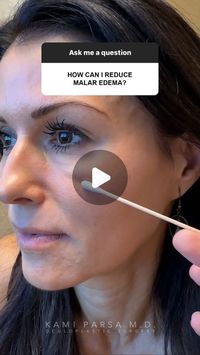 Kami Parsa on Instagram: "💬Reducing Malar Edema  In todays video we discuss ways to reduce malar edema (a fluid buildup around the cheek area). Recommendations include: ☑️Reducing salt ☑️Avoiding ultra-processed foods ☑️Identifying food allergies ☑️Avoid sleeping in your face  ☑️Using a jade roller and hyaluronic acid serum to help drain the fluid.  💡Remember, this should be a routine. So one jade roller in the morning isn’t going to magically make everything vanish.  For questions on pricing and appointments text us at 310.777.8880. _⁣⁣ 📱 Phone: 310.777.8880⁣⁣ 📬 Email: info@oculoplastic.info⁣⁣ 🌎 Website: www.oculoplastic.info⁣⁣ 📍Location: 465 N Roxbury Dr., Beverly Hills, Ca 90210⁣⁣ 🚘Valet Parking in parking garage⁣⁣ ✏️ Note: Individual results may vary.⁣⁣ 👩: This is an actual pat