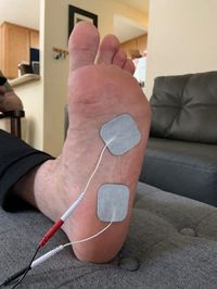 The correct TENS unit placement for plantar fasciitis – Optimize Health 365