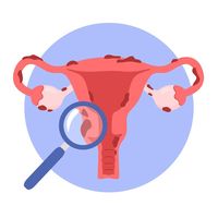 Ilustração do útero e endometriose. doen... | Premium Vector #Freepik #vector #reproducao #endometriose #genital #ginecologista