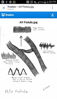 AV fistulas