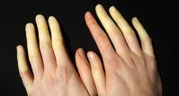 Maladie de Raynaud : se soigner naturellement avec des plantes