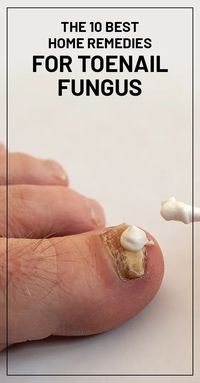 The 10 Best Home Remedies for Toenail Fungus