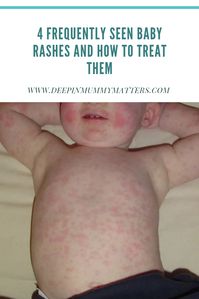 4 Frequently Seen Baby Rashes and How to Treat Them 2