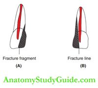 Traumatic Dental Injuries in Primary Dentition Notes - Anatomy Study Guide