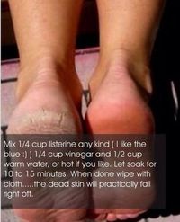 Dry Cracked Feet, and How to Fix Them...steve needs to do this!!