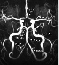 MR Angio Brain.