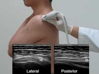 MSU shoulder exam and subdeltoid injection technique