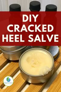 Looking for cracked heel remedies? You will find this cracked heel salve diy recipe with essential oils very helpful! #crackedheelsremedy essentialoildiy #crackedheelsalve