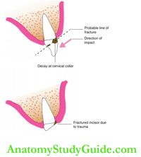 Traumatic Dental Injuries in Primary Dentition Notes - Anatomy Study Guide