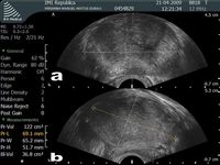 WK 6 PROSTATE PROSTATE ENLARGEMENT