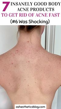 These body acne products and tips cleared my acne in less than a month I was so shocked. This post was insanely helpful I'm so happy I found it!!