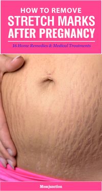 Here are 16 simple and effective home remedies along with medical treatments which will help reduce stretch marks after pregnancy. Read on!