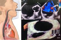 Trans-oesophageal echocardiography (TEE) is an invasive procedure like endoscopy. A long slender probe (like a camera) is gradually introduced per mouth and placed into the feeding tube behind the heart. This probe then emits sound waves that are then reflected from the heart to create an image on the monitor.