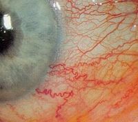 Ocular hyperemia: That's just eyespeak for dilated blood vessels on the white part of your eye.