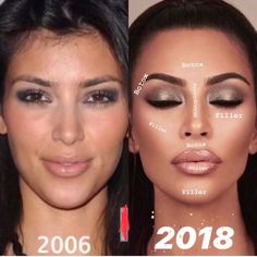 Contoured Makeup, Celebrity Surgery, Face Fillers, Botox Lips, Face Surgery, Plastic Surgery Gone Wrong, Cheek Fillers, Facial Fillers, Facial Contouring