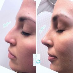 Nose Plastic Surgery, Nonsurgical Nose Job, Rhinoplasty Surgery, Canoga Park, Injectables Fillers, Nose Contouring, Life Changing Skincare