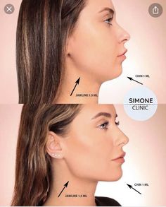 Chin Augmentation, Lips Inspiration, Botox Lips, Cheek Fillers, Beauty Procedures, Facial Fillers