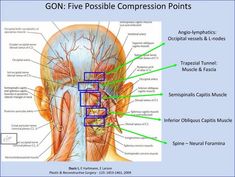 Trigeminal Nerve, Vertebral Artery, Occipital Neuralgia, Craniosacral Therapy, Chiari Malformation, Headache Prevention, Surgical Tech, Head Pain, George Town