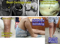 Autologous chondrocyte implantation for cartilage injuries (Cell treatment) This patient had cartilage loss after knee injury and was not able to walk. With new Autologous chondrocyte implantation technique we were able to regenerate cartilage at the site of injury. Within a short period of 3 months he was back to his normal life. He was able to walk, had full knee bending and was able to sit cross legged. Cross Legged