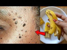 REMOVE SKIN TAGS OVERNIGHT WITH ONION | HOW TO GET RID OF SKIN TAG | SKIN TAG REMOVAL | Easy Beauty Recipes.We make videos for Homemade Beauty Care for women... Skin Tags On Face, Remove Skin Tags, Warts On Face, Onion Skin, Tag Remover, Mole Removal, Skin Tags, Banana Peel