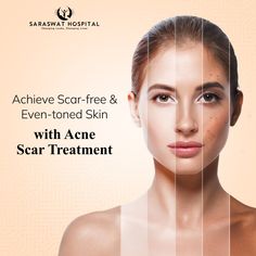 acne scar treatment agra Acne Poster Design, Facial Light Therapy, Skin Quotes, Acne Scaring, Acne Laser, Skin Transformation, Stubborn Acne, Skin Facts, Acne Free Skin