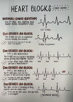 Cardiac Dysrhythmias Nursing, Cardiac Tamponade Nursing, Cardiology Medical Assistant, Heart Rythym Chart, How To Read Ekg, Cardiac Monitor Tech, Med Surg Cardiac, Ekg Study Notes, Ekg Electrode Placement