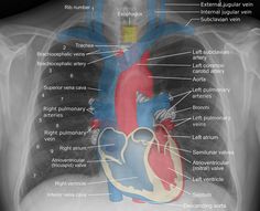 the heart is shown in this x - ray image, with labels on its chest