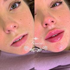 Nose Job And Lip Fillers, 1ml Of Lip Filler, Lip Fillers On Small Lips, Lip Fillers 2ml, Lip Injections Natural, Lip Injection Inspiration, Lip Implants Before And After, Russian Style Lip Fillers, 1.5 Ml Lip Filler