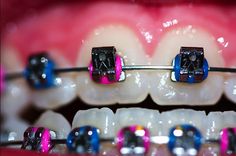 Great color choice here! Braces Color Wheel, Pink Braces, Types Of Braces