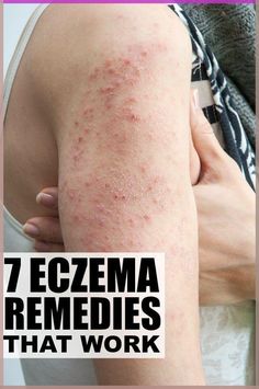 From environmental factors to diet and cream recommendations, these eczema remedies will help keep your eczema under control and prevent future flare ups. Cold Medicine, Cold Sores Remedies, Natural Sleep Remedies, Natural Cold Remedies, Natural Cough Remedies, Cough Remedies, Cold Sore, Hair Control, Cold Remedies