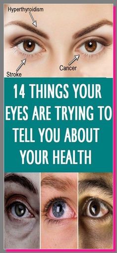 14 THINGS YOUR EYES ARE TRYING TO TELL YOU ABOUT YOUR HEALTH Migraine Aura, Protruding Eyes, Computer Vision Syndrome, Blurry Vision, Eyes Problems, Cardiovascular System, Eye Health, Healthy Tips, Way Of Life