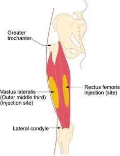 Emt Study, Greater Trochanter, B12 Injections, B12 Vitamin, Tourettes Syndrome