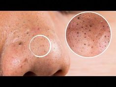 How To Remove Blackheads On The Nose : https://youtu.be/x3em1CVpvXc More Relevant Videos: How to Remove Blackheads From Nose & Face || Naturally at Home || :... White Heads On Nose, Remove Blackheads From Nose, How To Remove Blackheads, Steaming Your Face, To Remove Blackheads, Blackhead Mask, Prevent Pimples