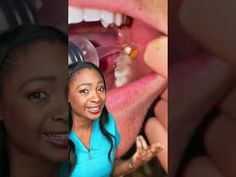 Subscribe for a KitKat 🍫YouTubehttps://youtube.com/c/AvaleneRFollow onTik Tok: https://vm.tiktok.com/ZMdpPnmQy/Instagram: http://www.Instagram.com/avalene.r... Things To Eat After Wisdom Teeth Removal, What To Eat After Wisdom Teeth Removal, Foods To Eat After Wisdom Teeth Removal, Wisdom Teeth Food Meals, Wisdom Teeth Recovery Tips, Wisdom Tooth Pain Relief, Getting Wisdom Teeth Out, Soft Foods After Surgery Teeth, Wisdom Teeth Food