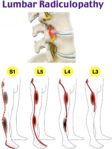 Psoas Iliaque, Punkty Spustowe, Lumbar Pain, Chronic Back Pain, Bolesti Chrbta, Middle Back Pain, Muscle Anatomy