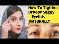 Tighten Eyelid Skin, How To Tighten Eyelid Skin, Eye Lid Lift Droopy Eyelids, Tighten Eyelids, Saggy Eyes, Eyelid Wrinkles, Skin Tightening Essential Oil, Saggy Eyelids, Drooping Eyelids